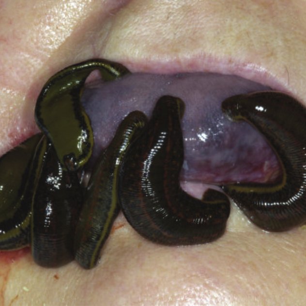 Name:  Medicinal-leeches-applied-to-the-tongue_Q640.jpg
Views: 289
Size:  53.9 KB